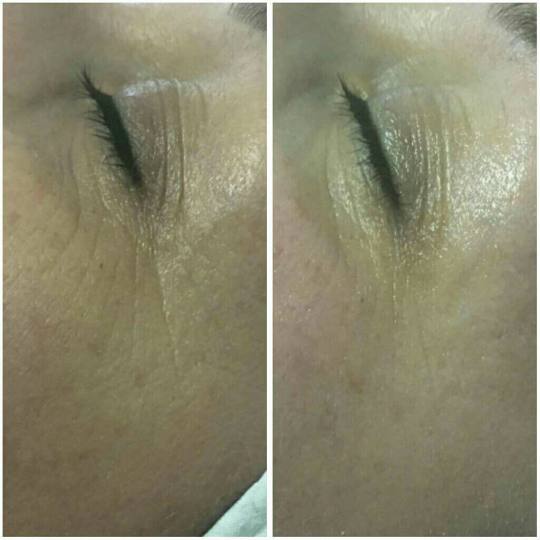 Look at me #beograd Tretmani protiv bora 3D Wrinkle tretman lica rezultat nakon jednog tretmana