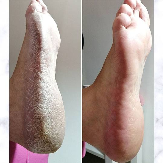 My Beauty Corner #beograd Estetski pedikir Ruski pedikir sa lakiranjem Ruski pedikir uz pomoc profi 