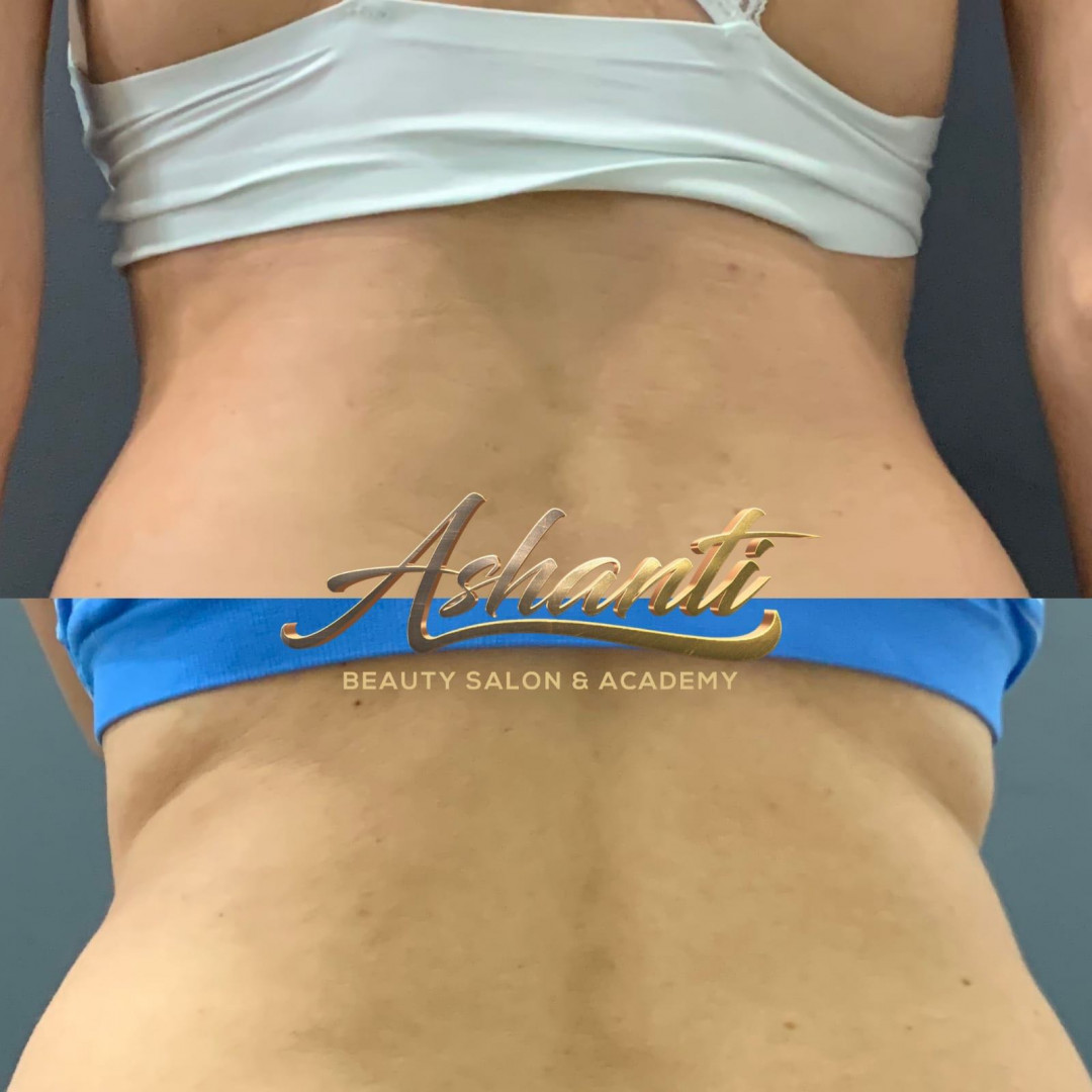 Ashanti Beauty Salon & Academy #beograd Masaža za mršavljenje Premium Maderoterapija - paket od 5 tretmana