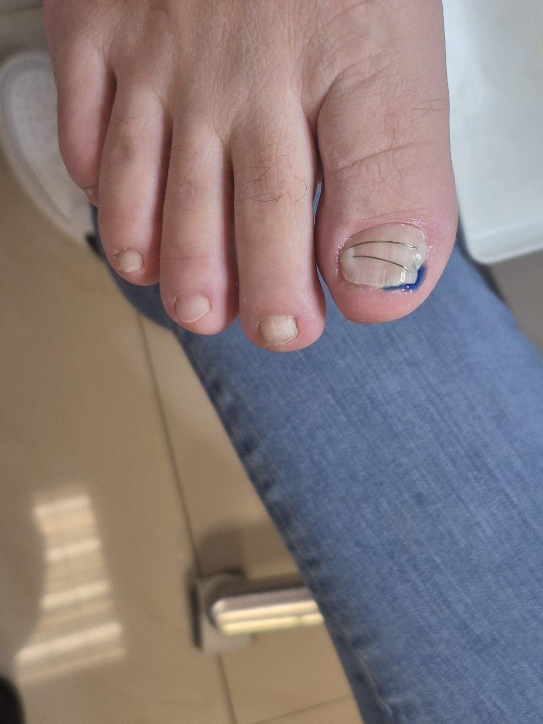 Ortonoksija (titanova nit)urasli nokat - Valija, Beograd Piling lica Lice Piling lica, Beograd, Žarkovo, Cerak, Bele vode