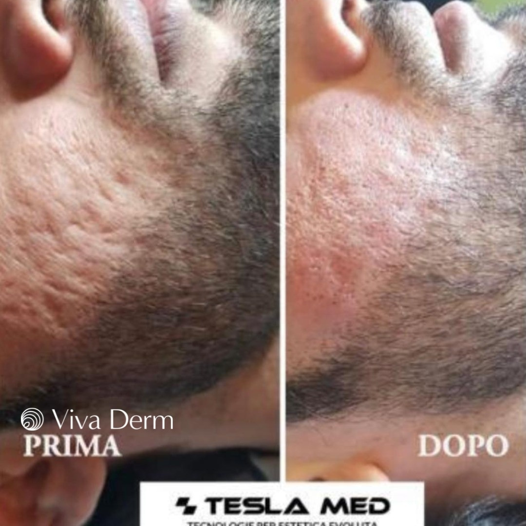 Viva Derm #beograd Tretmani tela Tesla MED - Dermaresurface (uklanjanje ožiljaka)