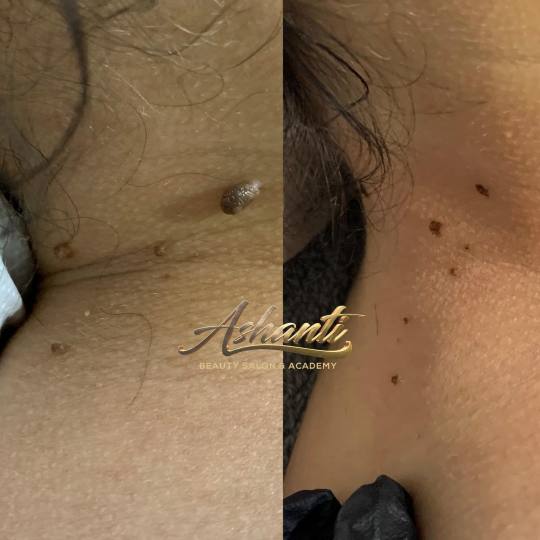Ashanti Beauty Salon & Academy #beograd Tretman lica Plasma pen - skidanje do 10 bradavica
