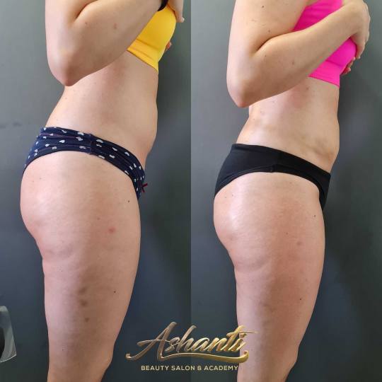 Ashanti Beauty Salon & Academy #beograd Masaža za mršavljenje Dermapen - regija lica