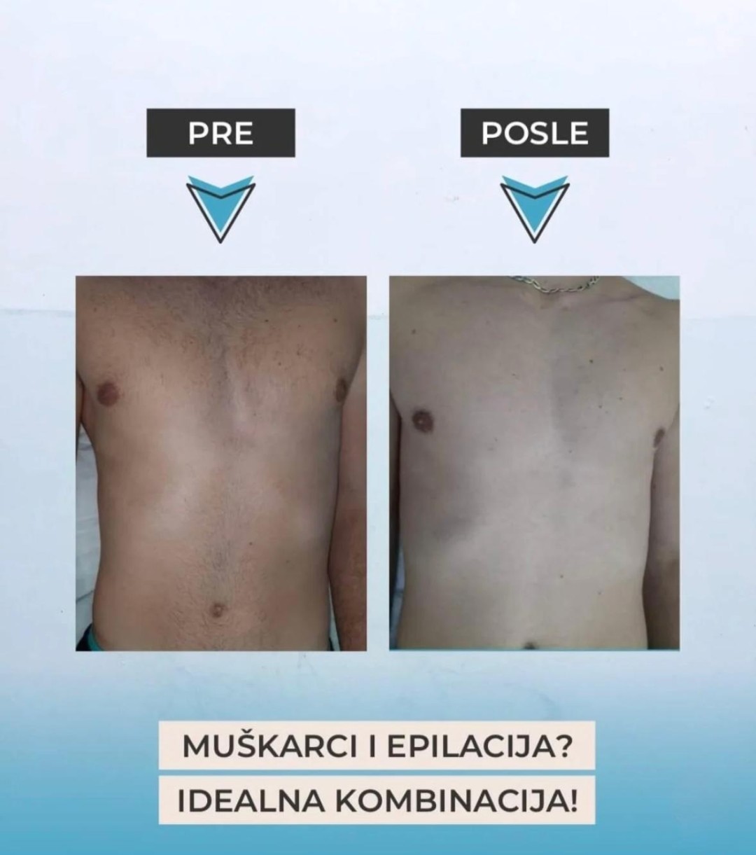 Laserska epilacija grudi - za muškarce - Sylk Wax, Jagodina Laserska epilacija Depilacija Laserska epilacija, Jagodina, Centar