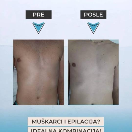 Sylk Wax #jagodina Laserska epilacija Laserska epilacija grudi - za muškarce