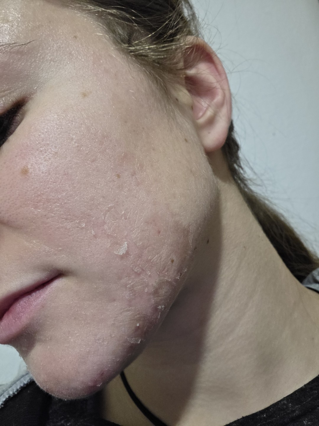 Estetski centar Đina #beograd Tretman lica TCA srednje duboki piling lica