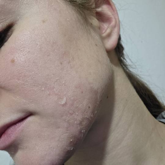 Estetski centar Đina #beograd Tretman lica TCA srednje duboki piling lica