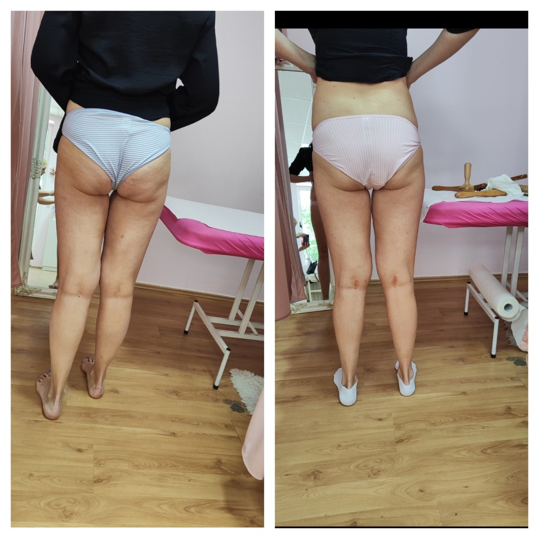 Mademoiselle Natalie studio #beograd Anticelulit LUX 10 maderoterapije+10 limfne drenaze+ brazilske madero+10 pakovanja