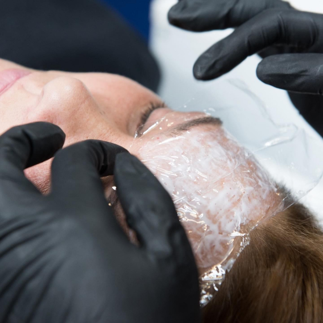 Plasma pen - horizontalne bore čela - Ashanti Beauty Salon & Academy, Beograd Tretman lica Lice Tretman lica, Beograd, Voždovac