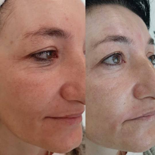 Olja Beauty #beograd Lifting / zatezanje kože HiFu tretman lica - po regiji 3D HIFU nehirusko zatez