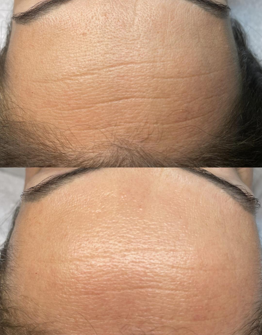 Mask #beograd Tretman lica Hidrafacial tretman lica