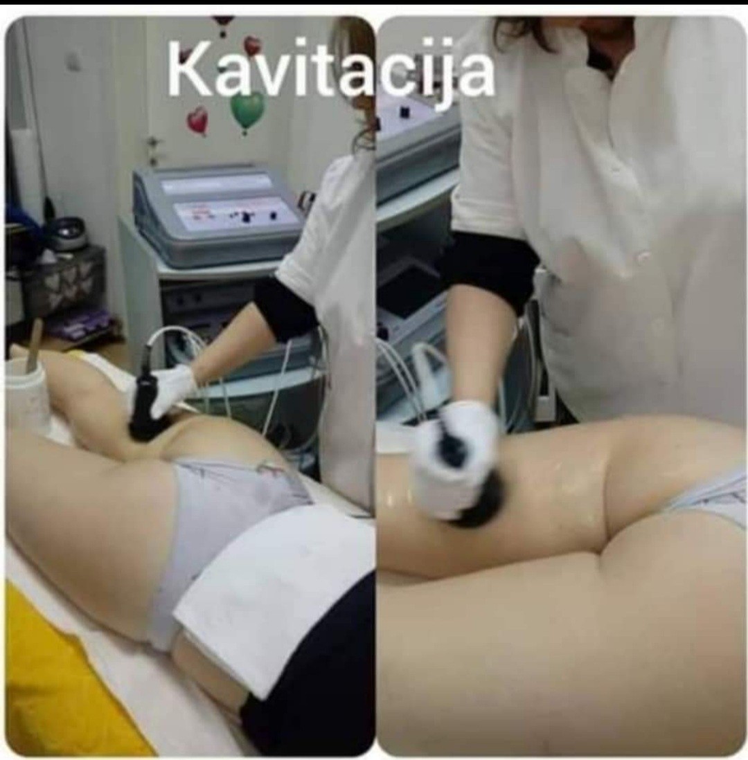 Studio Venera J #beograd Tretmani tela Kavitacija - paket od 5 tretmana