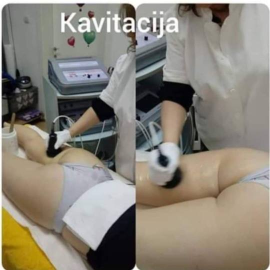 Studio Venera J #beograd Tretmani tela Kavitacija - paket od 5 tretmana