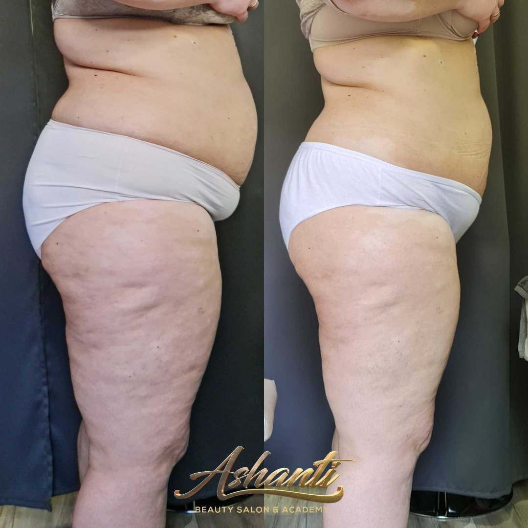 Ashanti Beauty Salon & Academy #beograd Tretmani za mršavljenje Vacuslim 48 - noge + stomak + ruke - paket od 5 tretmana