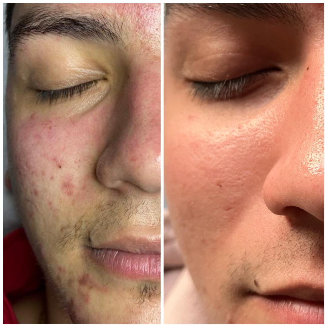 Microneedling tretman - lice - Belle Ana, Beograd Tretman lica Lice Tretman lica, Beograd, Vračar, Čubura, Crveni krst