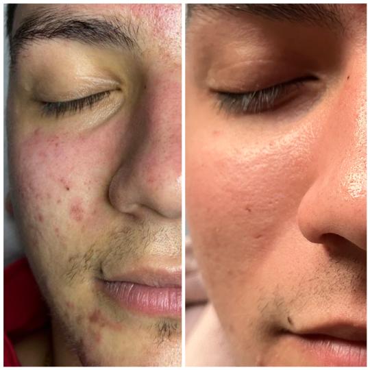 Belle Ana #beograd Tretman lica Microneedling tretman - lice