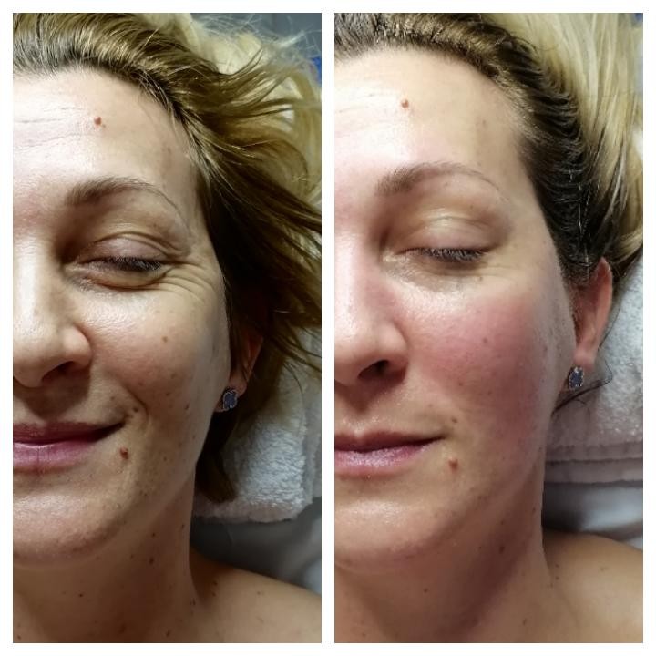 Paris Royal #novisad Tretman lica Miracle face(antiage masaža)