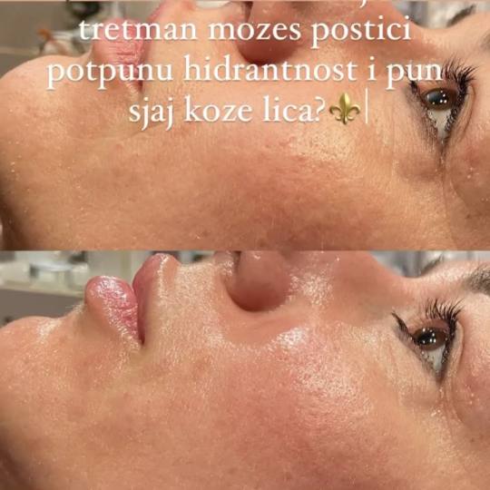 La Femme #beograd Tretman lica Tretman lica kiseonikom OXYGEN ⚜️Hidratacija, regeneracija. Dugor