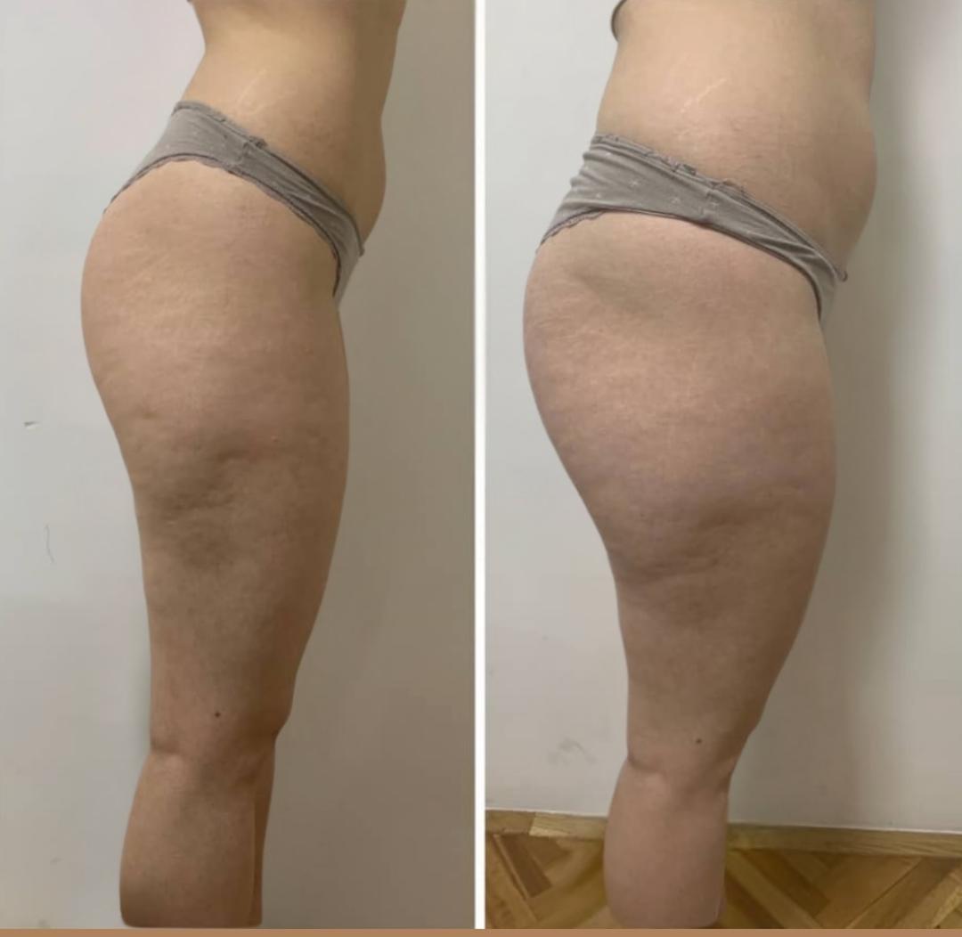 Anticelulit ručna masaža - Zgodnica, Beograd Anticelulit masaža Masaža Anticelulit masaža, Beograd, Jajinci