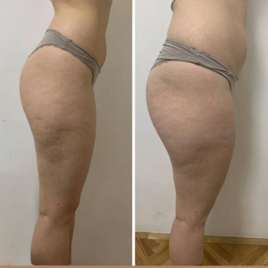 Zgodnica #beograd Anticelulit masaža Anticelulit ručna masaža Anticelulit paket od 10 masaža nam