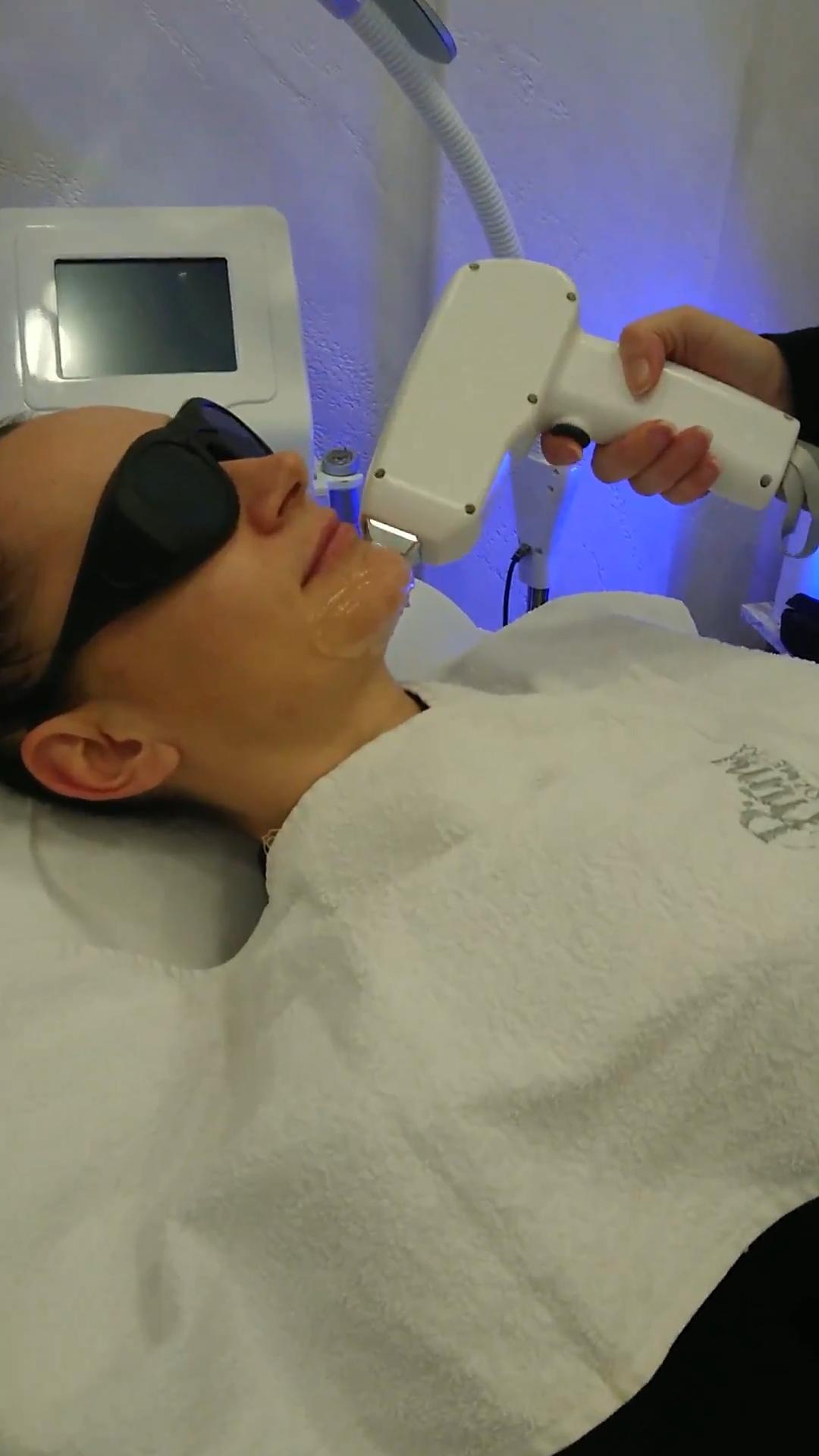 Laser lab by Ceca #novisad Laserska epilacija Laserska epilacija celog lica - za dame