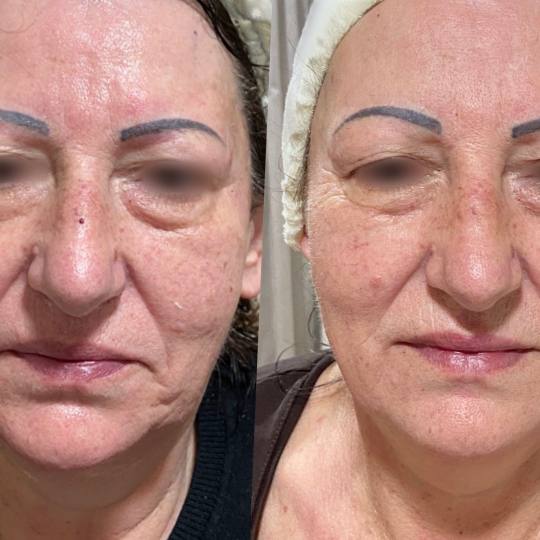 Fam Beauty Box #beograd Tretman lica
