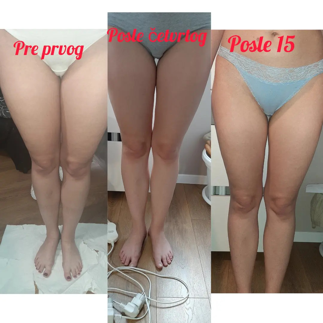 Elin Sary Mary Kutak #beograd Kavitacija Kavitacija + elektrostimulacija + termo ćebe + Vacumslim 48 - paket od 15 tretmana