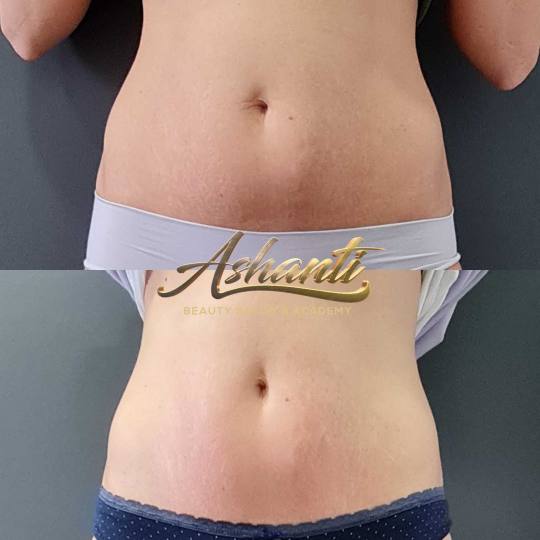 Ashanti Beauty Salon & Academy #beograd Radiotalasni i ultrazvučni tretmani Radiotalasni lifting - 