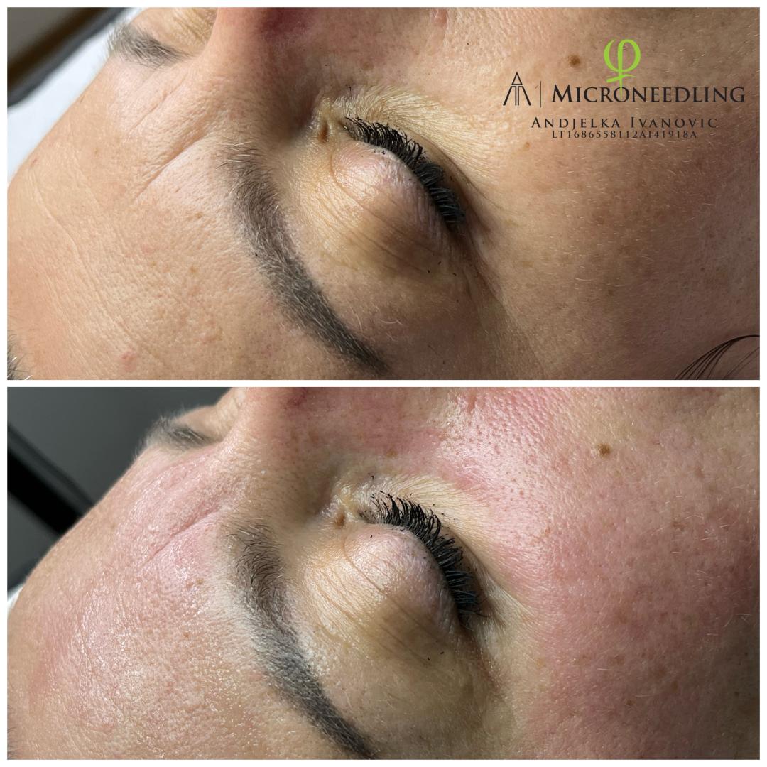 Microneedling tretman - lice - Belle Ana, Beograd Tretman lica Lice Tretman lica, Beograd, Vračar, Čubura, Crveni krst