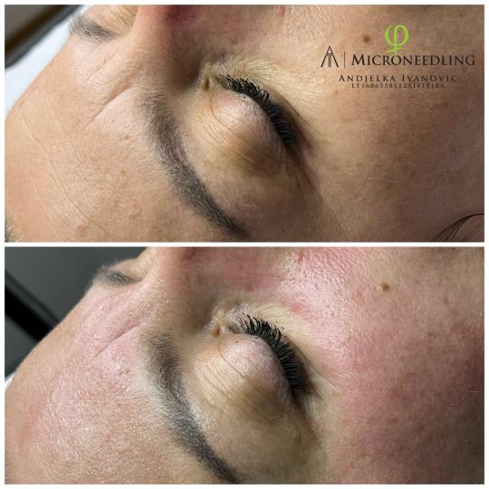Belle Ana #beograd Tretman lica Microneedling tretman - lice