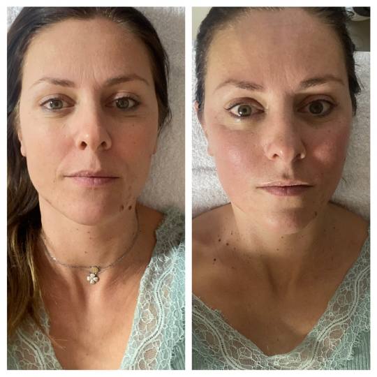 Ritual face and body #beograd Tretman lica Rezultat nakon jednog tretmana. Facegym i DermaOxy tretma