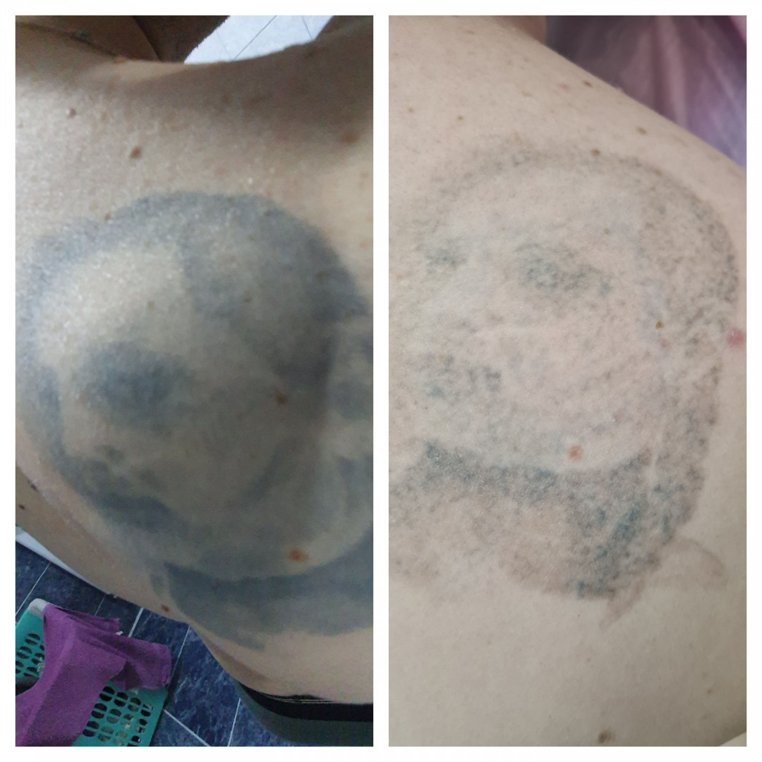 Laser centar Delight #beograd Uklanjanje tetovaža Uklanjanje tetovaže laserom - 1 boja 1cm2 - po tretmanu