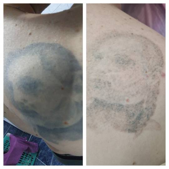 Laser centar Delight #beograd Uklanjanje tetovaža Uklanjanje tetovaže laserom - 1 boja 1cm2 - po t