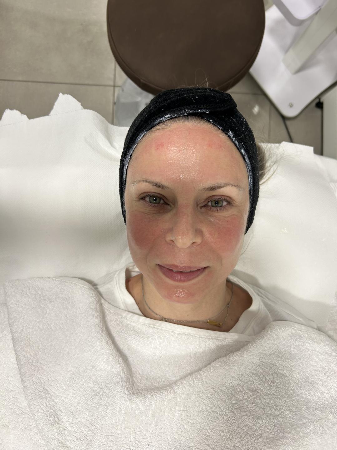 Sandra estetik studio #beograd Tretman lica Dermapen tretman lica + NAD +