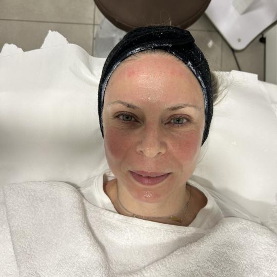 Sandra estetik studio #beograd Tretman lica Dermapen tretman lica + NAD + Hvala Vam na poverenju i i