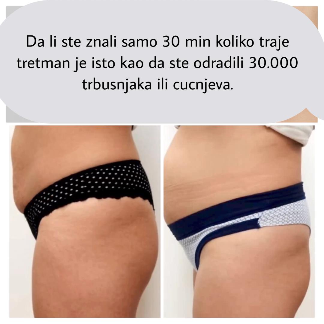 EMS tretman - 2 regije - Belle Ana, Beograd Tretmani tela Telo Tretmani tela, Beograd, Vračar, Čubura, Crveni krst