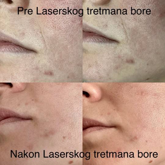 Poliklinika Marić #novisad Laserski tretmani lica Laserski tretman usana LipLase