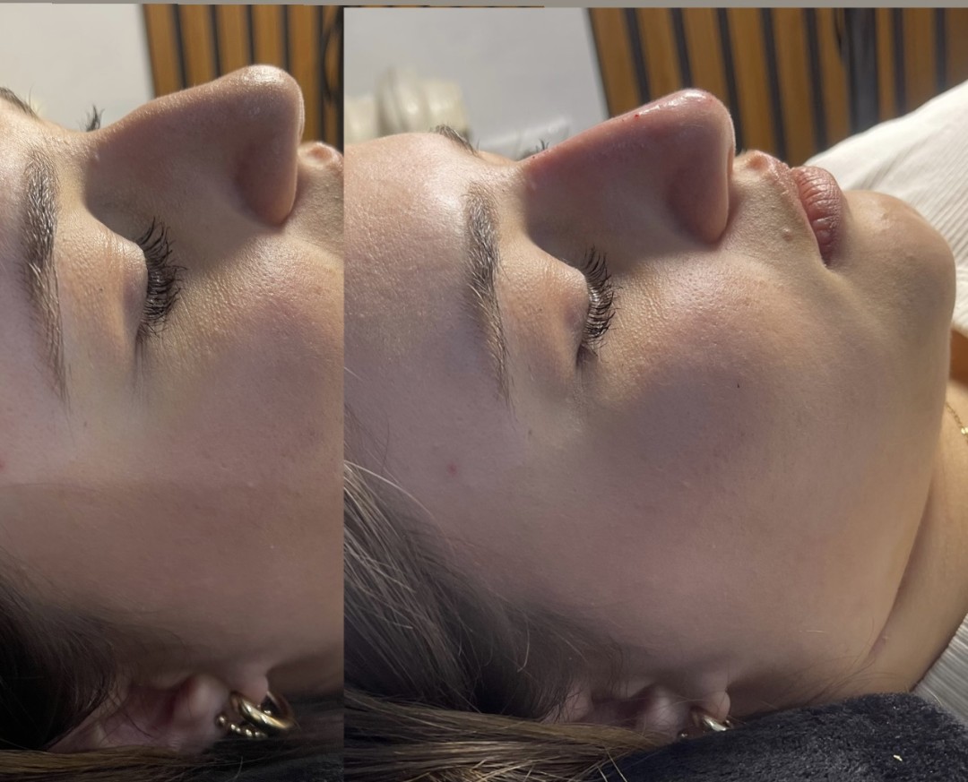 Estetik beauty centar #pancevo Tretman lica Hijaluronski filer iglom-0,5 ml