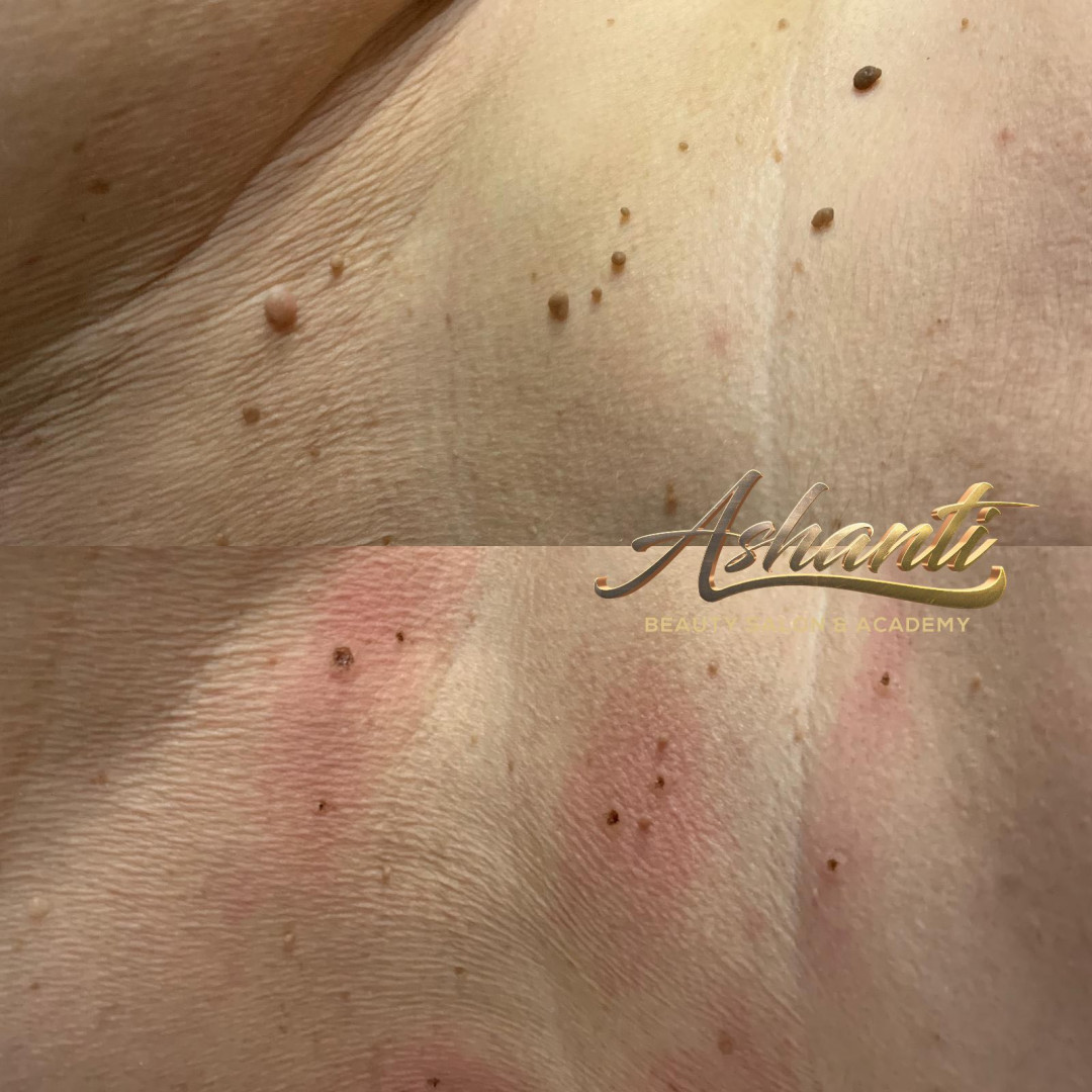 Uklanjanje virusnih bradavica - Ashanti Beauty Salon & Academy, Beograd Tretman lica Lice Tretman lica, Beograd, Voždovac