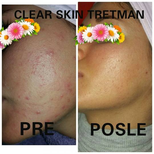 Beauty queen M&M #beograd Tretman lica Mikrodermoabrazija ili ultrazvucno ciscenje, maska Clear skin