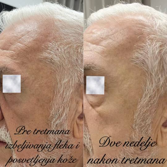 Estetski centar Vlahović #beograd Tretman lica Dermapen - hiperpigmentacija (fleke )