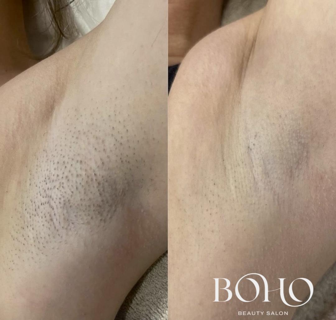 Boho Beauty #beograd Laserska epilacija Laserska epilacija pazuha - za dame