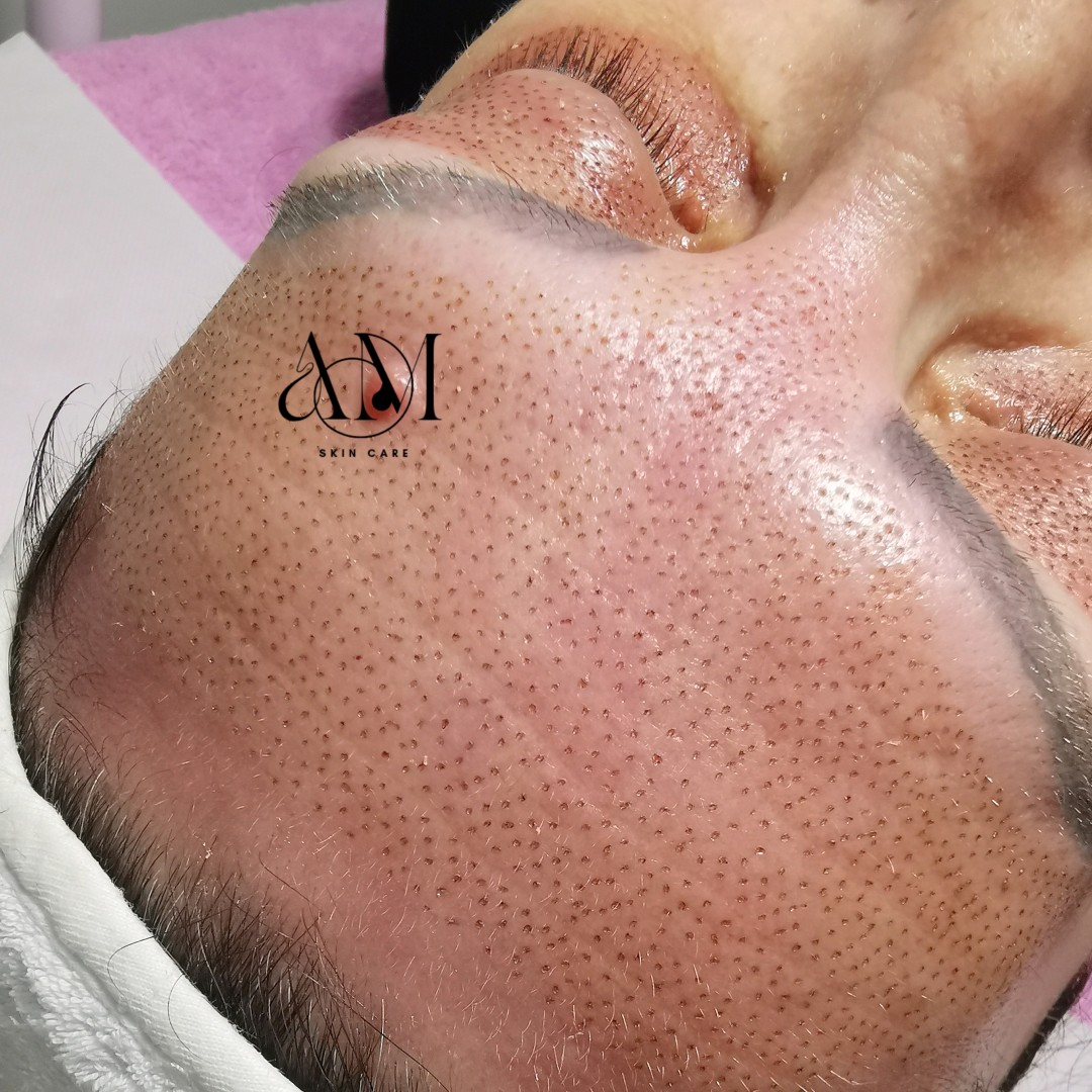 AM BEAUTY STUDIO #odzaci Radiotalasni i ultrazvučni tretmani Plasma pen - čelo