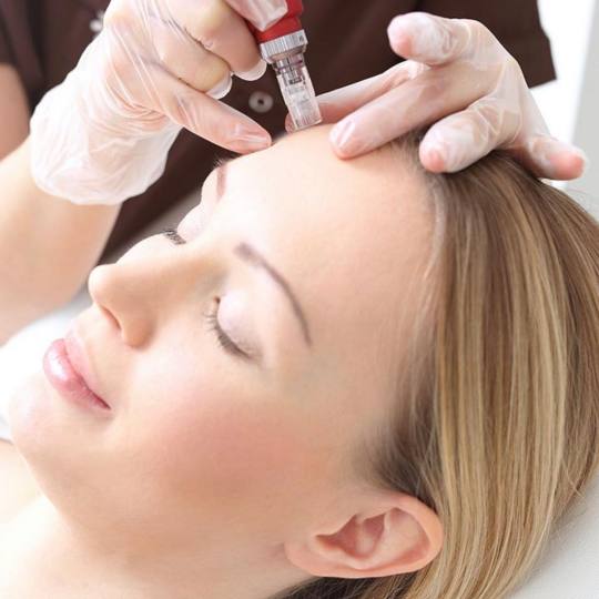 Vortex #beograd Mezoterapija lica Mezoterapija lica dermapenom mezoteraoija