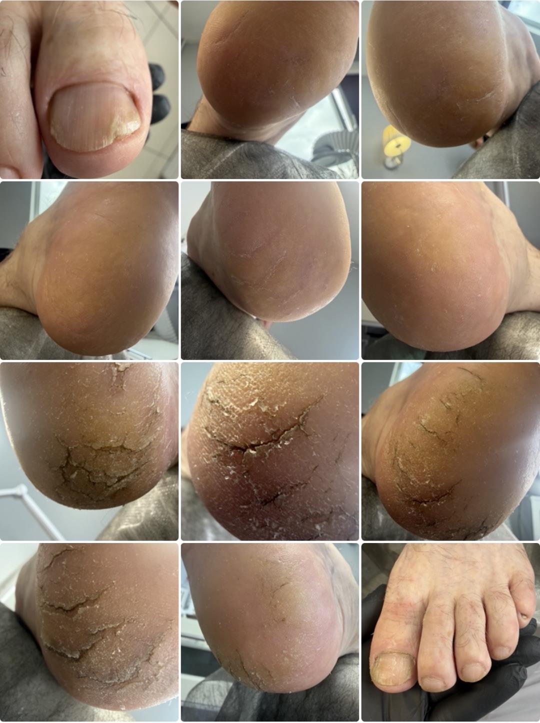 Medicinski pedikir - pukotine / žuljevi / kurje oči - RS beauty studio, Novi Sad Medicinski pedikir Nokti Medicinski pedikir, Novi Sad, Rotkvarija, Podbara, Salajka