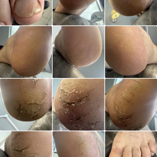 RS beauty studio #novisad Medicinski pedikir Medicinski pedikir - pukotine / žuljevi / kurje oči