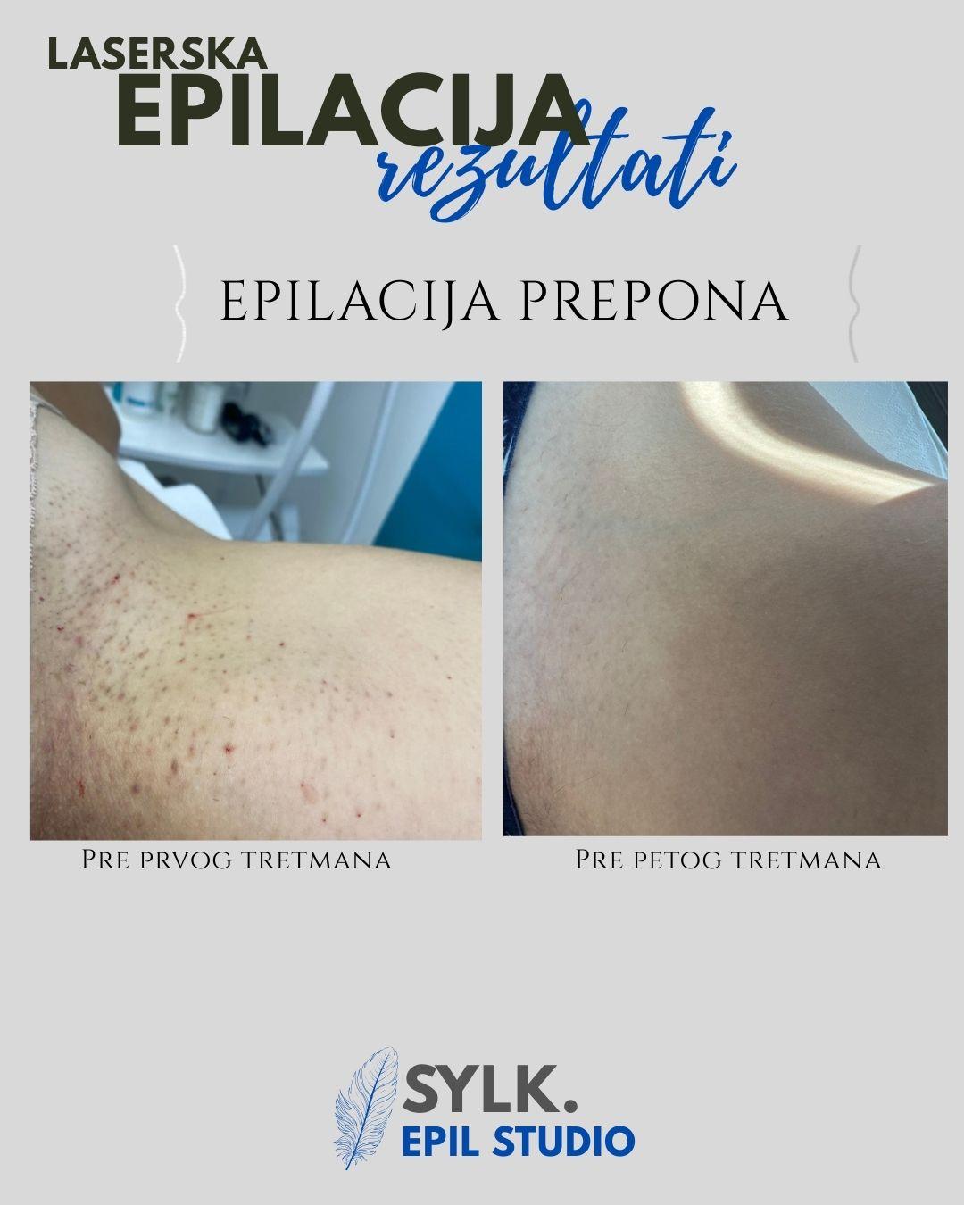 SYLK. Epilstudio Jagodina #jagodina Laserska epilacija Laserska epilacija prepona - za dame