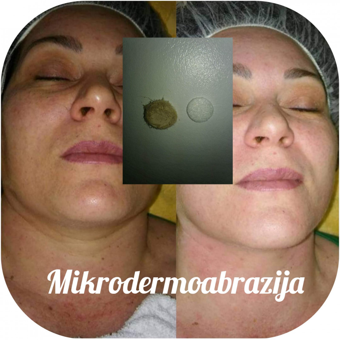 Elin Sary Mary Kutak #beograd Mikrodermoabrazija Mikrodermoabrazija lica