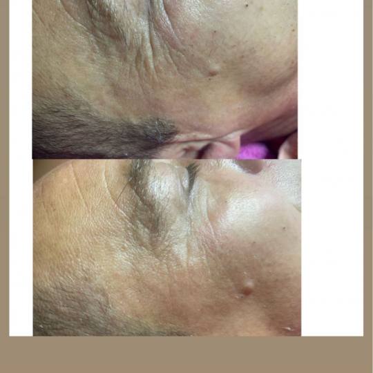 Lancier Beauty Expert #beograd Tretman lica Full Beauty tretman