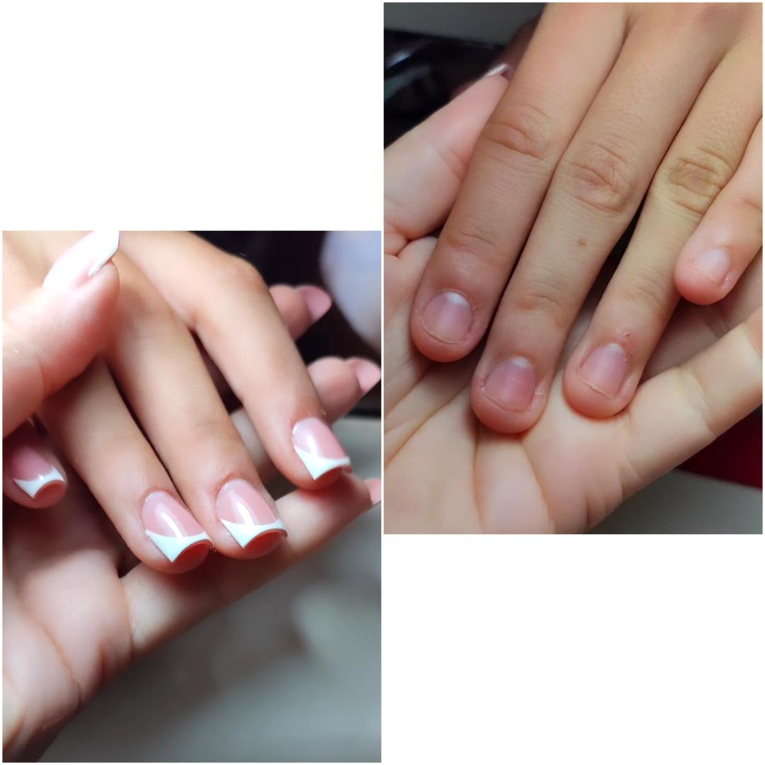 Izlivanje izgrickanih noktiju gelom - Kala Beauty lab, Beograd Izlivanje noktiju Nokti Izlivanje noktiju, Beograd, Voždovac